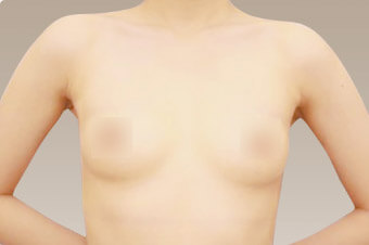 コンデンスリッチ豊胸の術前症例サンプル