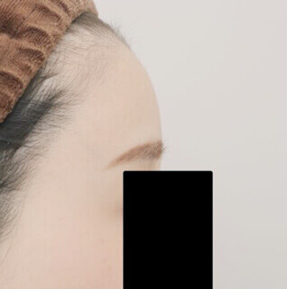 コンデンスリッチフェイス（おでこへの脂肪注入）の術後写真