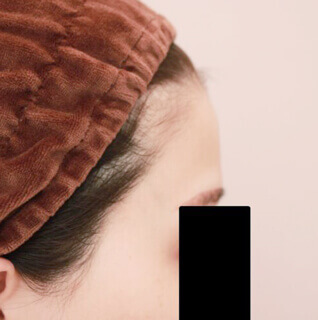 コンデンスリッチフェイス（おでこへの脂肪注入）の術前写真