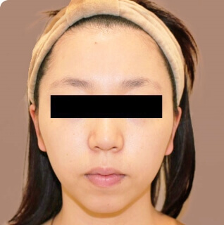 コンデンスリッチフェイス（頬のこけ）【女性/20歳】の術前写真