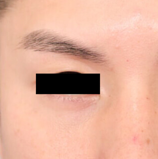 コンデンスリッチフェイス（目の下のクマ）の術後写真