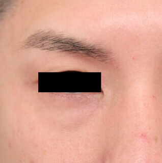 コンデンスリッチフェイス（目の下のクマ）の術前写真