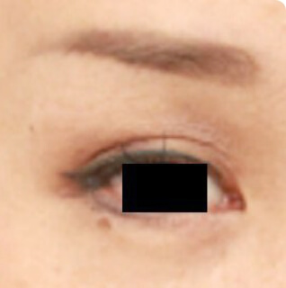 マイクロCRF注入（目の上の窪み）の術後写真