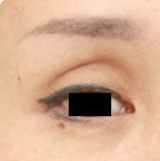 マイクロCRF注入（目の上の窪み）の術前写真