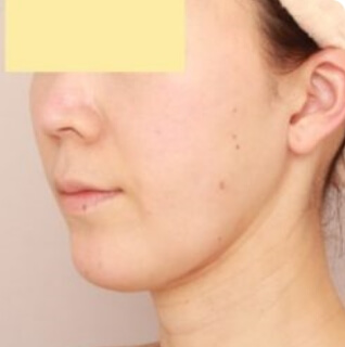 マイクロCRF注入（ほうれい線）の術後写真