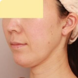 マイクロCRF注入（ほうれい線）の術前写真