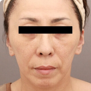 コンデンスリッチフェイス（フルフェイス）の術後写真