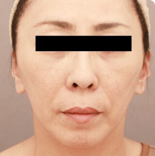 コンデンスリッチフェイス（フルフェイス）の術前写真