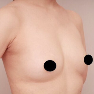 コンデンスリッチ豊胸【女性/38歳】の術後写真