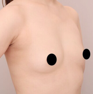 コンデンスリッチ豊胸【女性/38歳】の術前写真