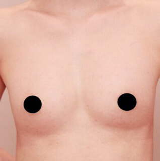 瘦せ型の方のコンデンスリッチ豊胸【女性/38歳】の術後写真