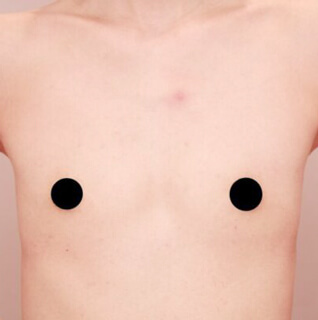 瘦せ型の方のコンデンスリッチ豊胸【女性/38歳】の術前写真