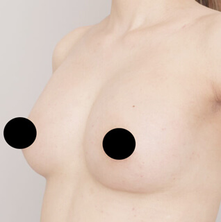 授乳後のコンデンスリッチ豊胸【女性/41歳】の術後写真