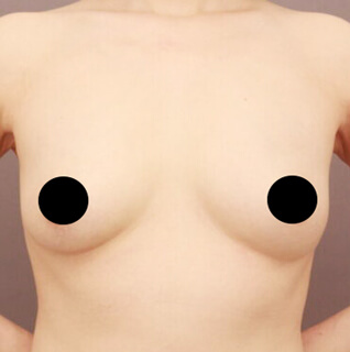 シリコンバック抜去＋コンデンスリッチ豊胸【女性/46歳】の術後写真