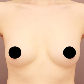 シリコンバック抜去＋コンデンスリッチ豊胸【女性/46歳】の術前写真