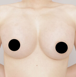 2回目のコンデンスリッチ豊胸【女性/37歳】の術後写真