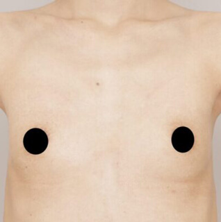 2回目のコンデンスリッチ豊胸【女性/37歳】の術前写真