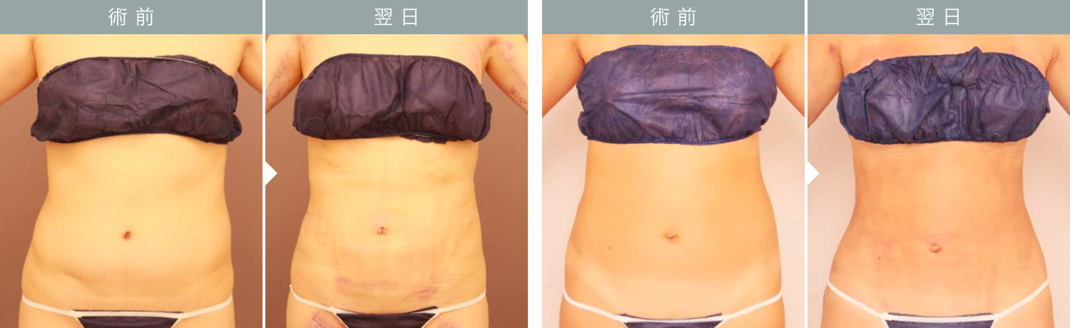 ダウンタイムの経過：腹部（お腹・腰）翌日