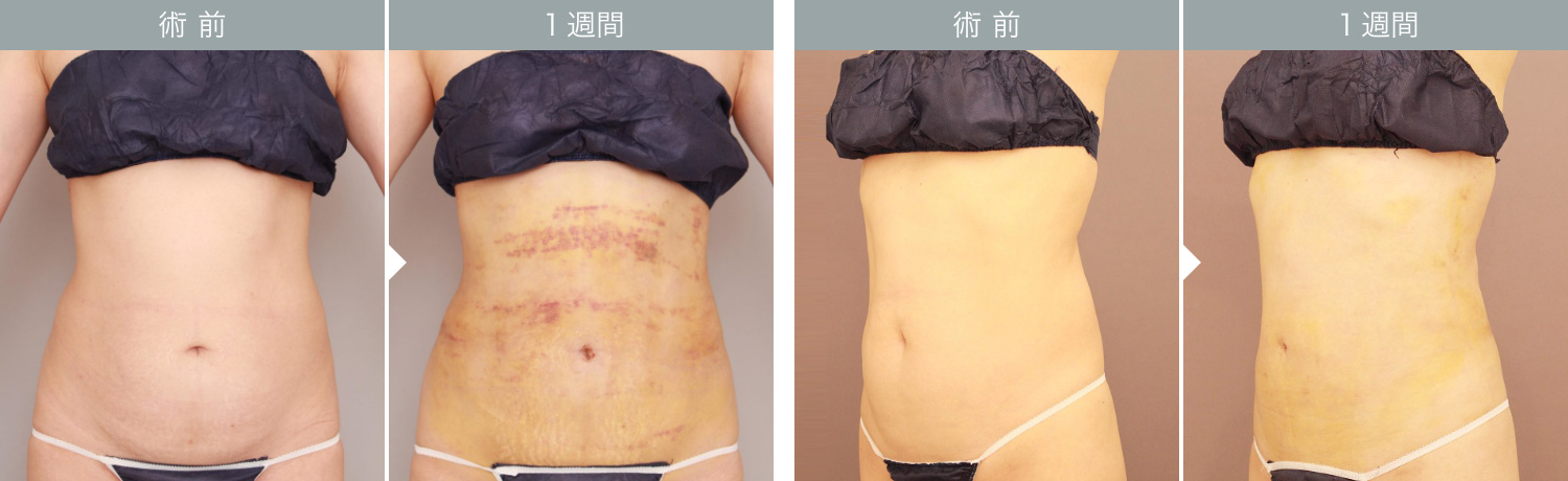 ダウンタイムの経過：腹部（お腹・腰）1週間