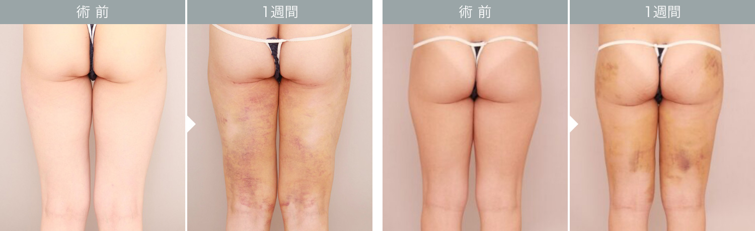 ダウンタイムの経過：太もも 1週間