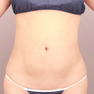 ベイザー脂肪吸引（腹部全体＋胸下＋腰）【女性［37歳］6ヶ月】の術後写真