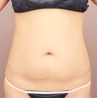 ベイザー脂肪吸引（腹部全体＋胸下＋腰）【女性［37歳］6ヶ月】の術前写真