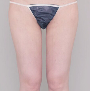 ベイザー脂肪吸引（太もも全周＋臀部）【女性［28歳］1ヶ月】の術後写真