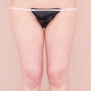 ベイザー脂肪吸引（太もも全周＋臀部）【女性［28歳］1ヶ月】の術前写真